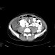 Gelatinous tumor spread in the abdominal cavity: CT - Computed tomography